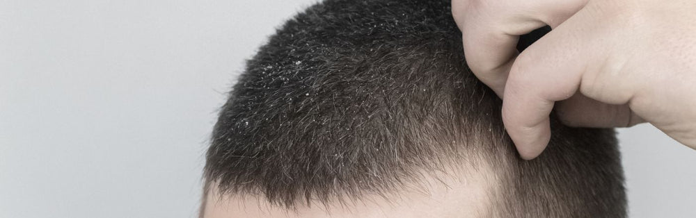 Are Dandruff and Hair Loss Linked?
